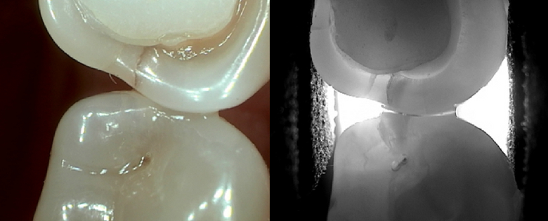 The Evolution Of Caries Detection Technology
